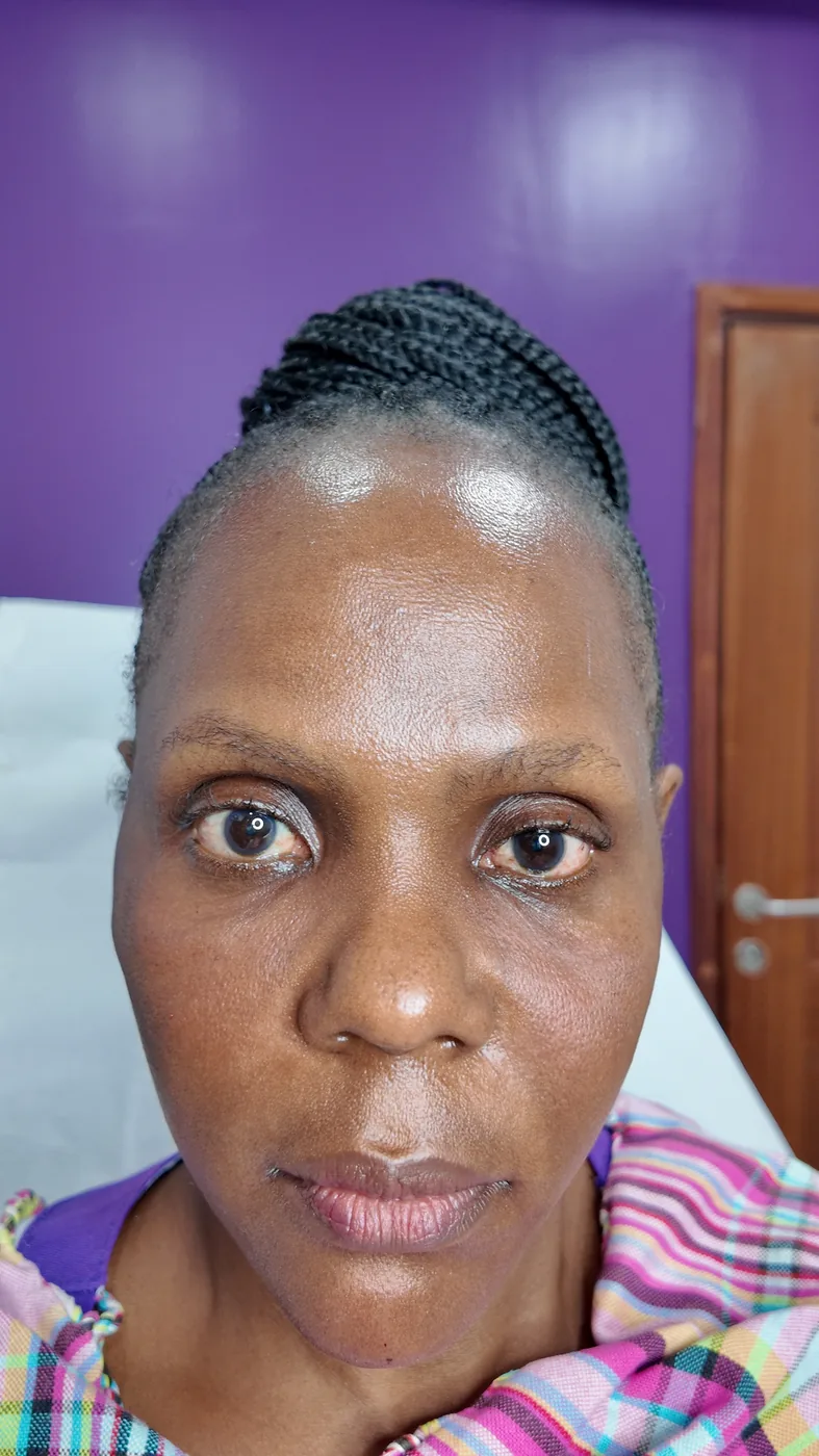 Dermal Fillers offer at Refine Clinic