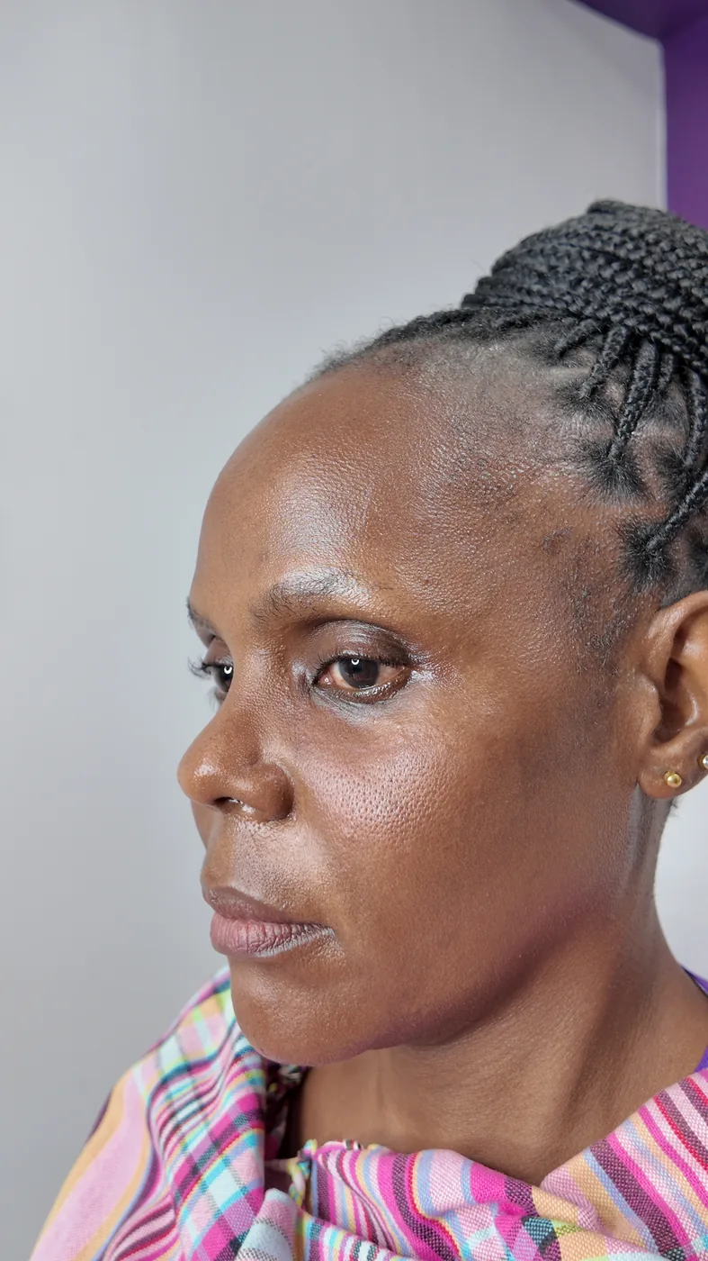 Dermal filler after — Relaxed expression