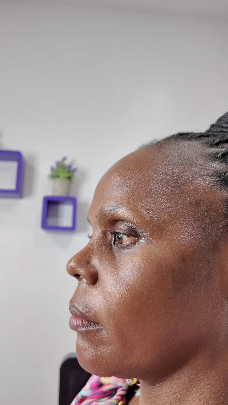 Dermal filler before — Relaxed expression