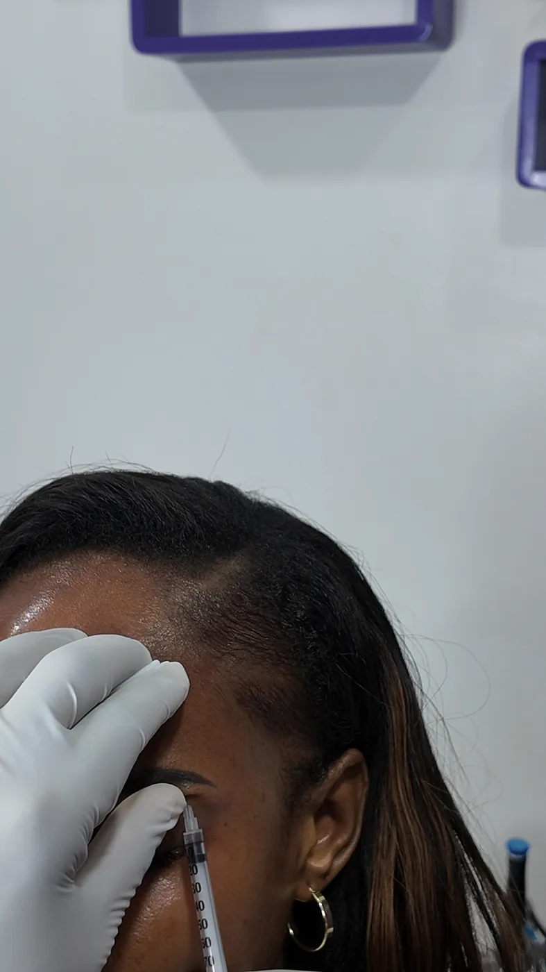 Botox session at Refine Clinic — Forehead injection points