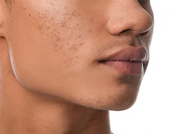 Acne After
