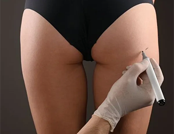 Non Surgical Brazilian Butt Lift at Refine Skin and Body Clinic.