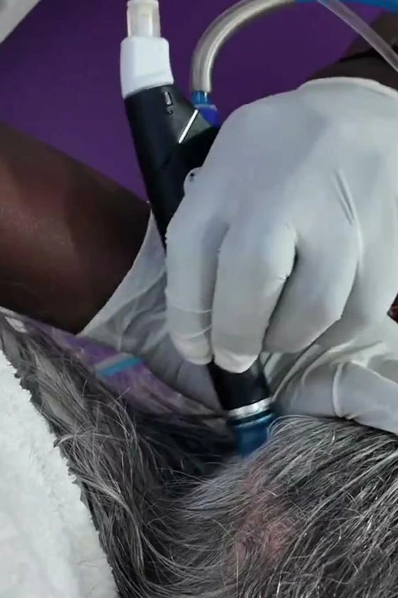 HydraFacial Keravive peptide follicle infusion at Refine Skin and Body Clinic Kampala