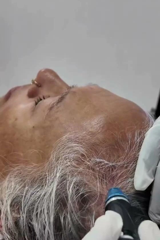 HydraFacial Keravive scalp cleanse and exfoliation at Refine Skin and Body Clinic Kampala