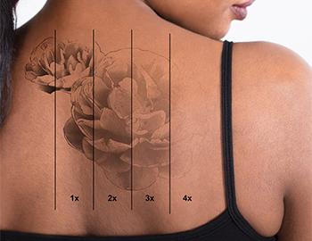 Laser Tattoo Removal In Uganda at Refine Skin and Body Clinic.