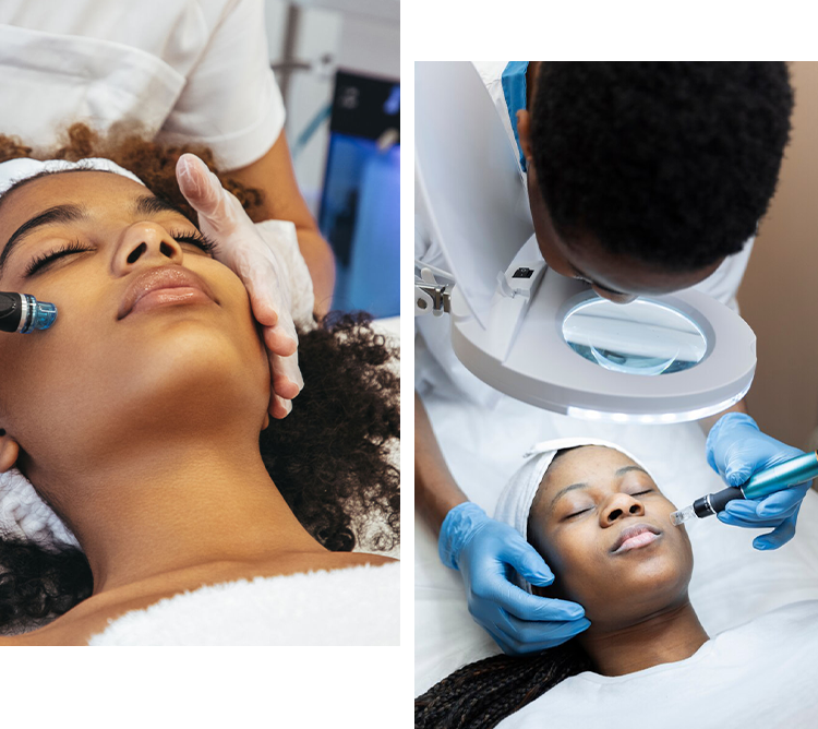 Rf Microneedling at Refine Skin and Body Clinic.
