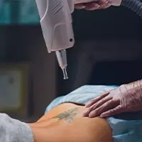 Laser Tattoo Removal