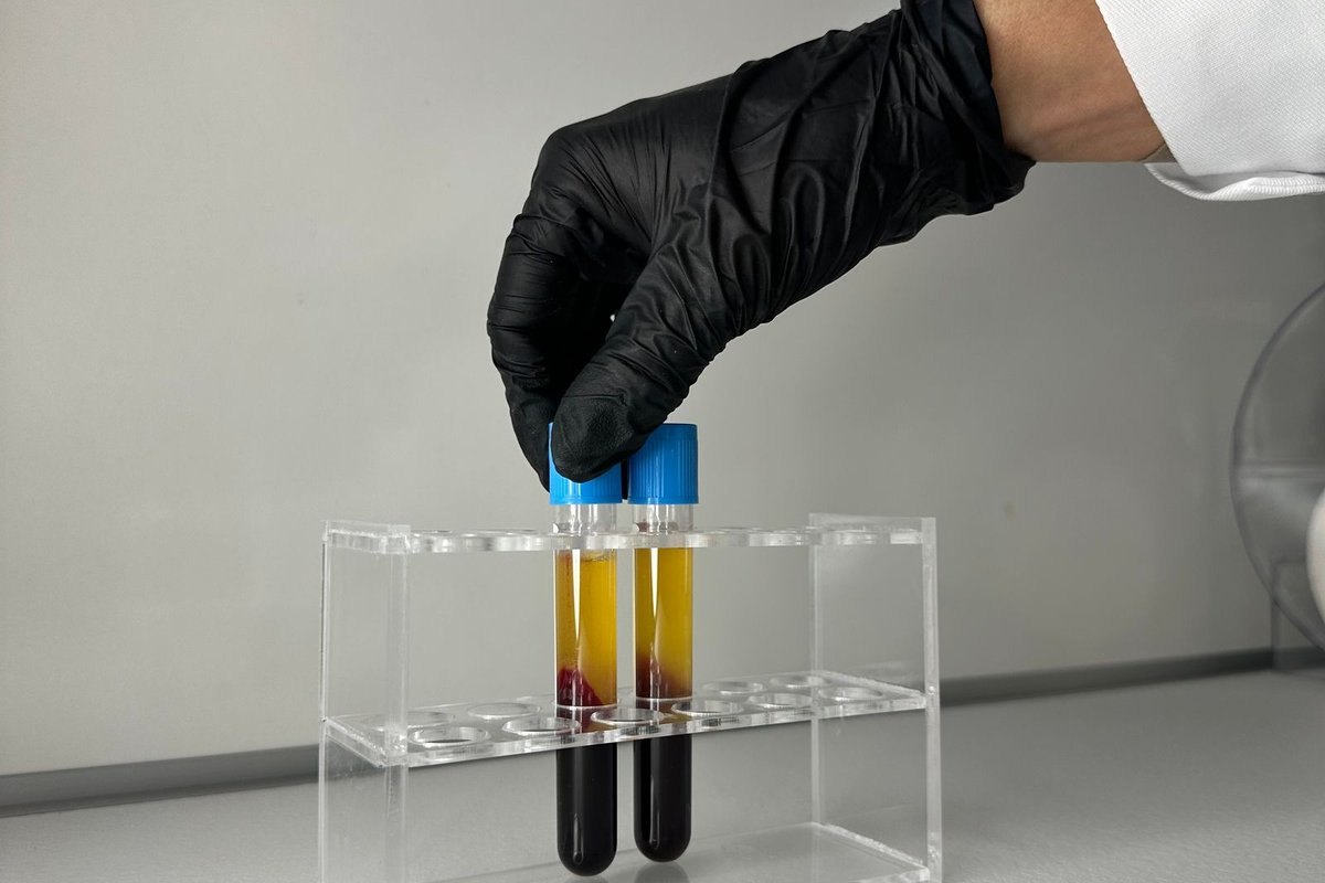 How Long Do PRP Results Last?