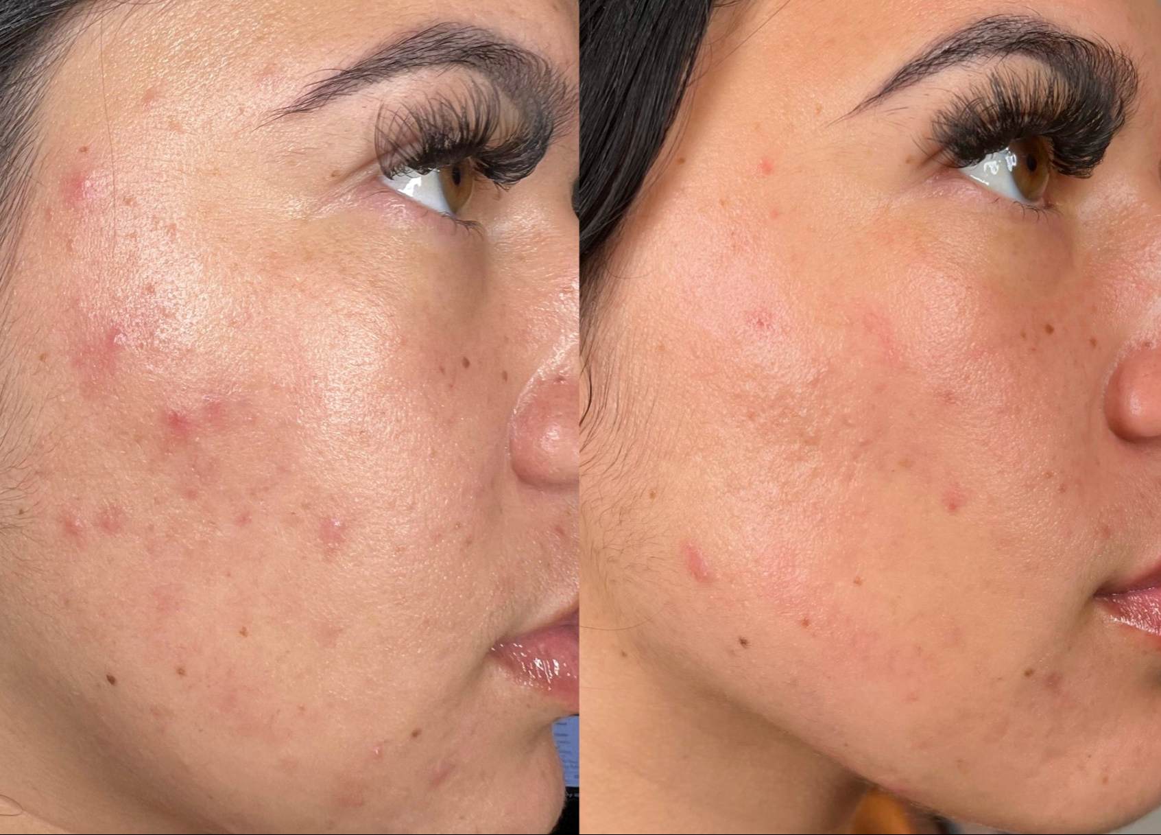 Before and After HydraFacial Treatment for Acne and Blemishes