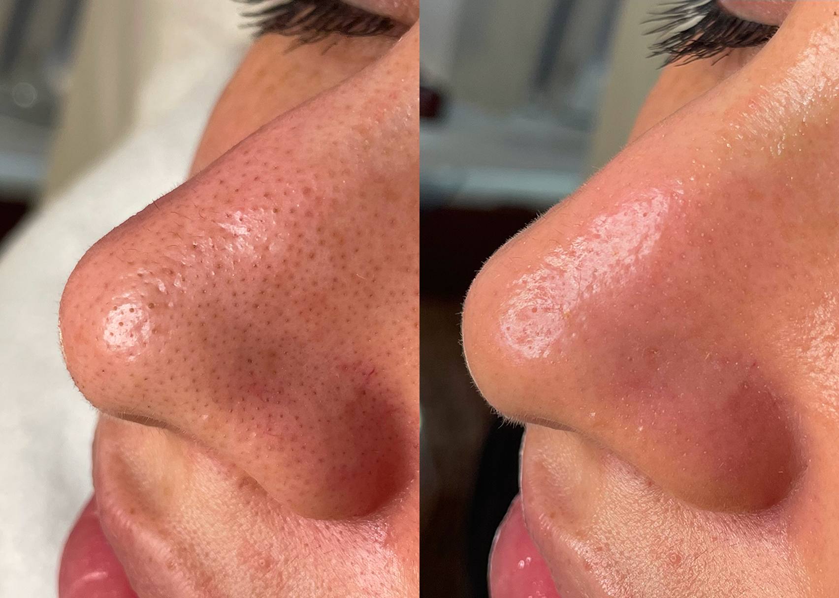 Before and After HydraFacial Treatment for Clogged Pores and Congestion