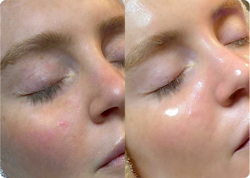 Before and After HydraFacial Treatment for Dull and Dehydrated Skin