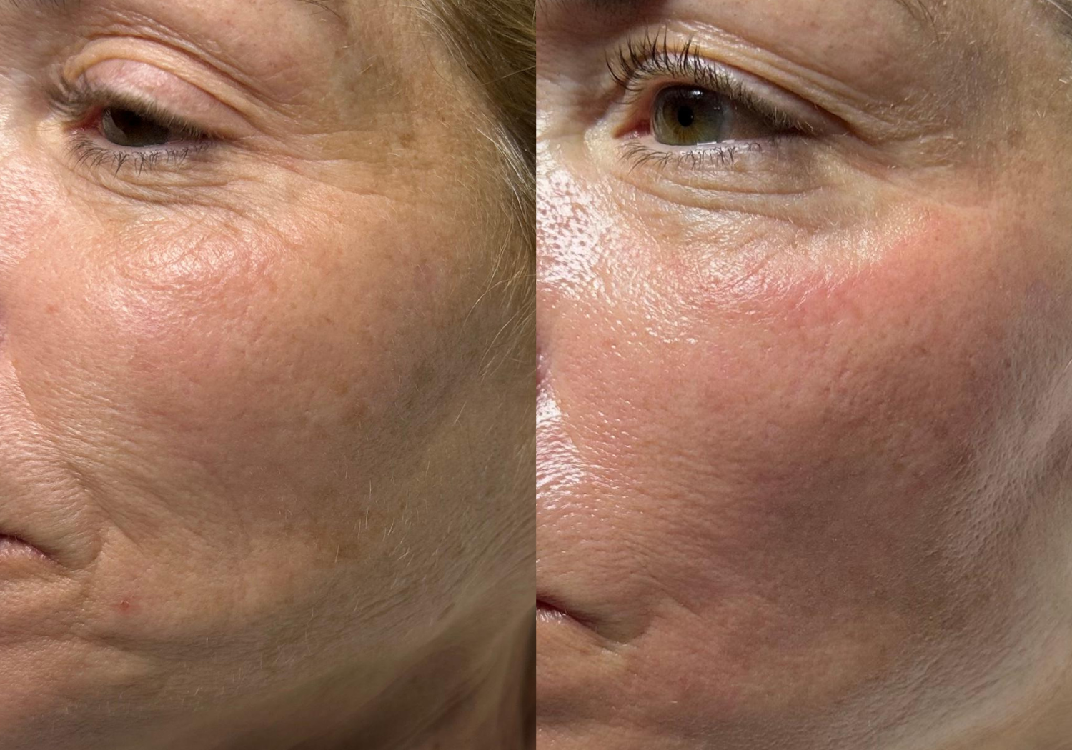 Before and After HydraFacial Treatment for Fine Lines and Wrinkles