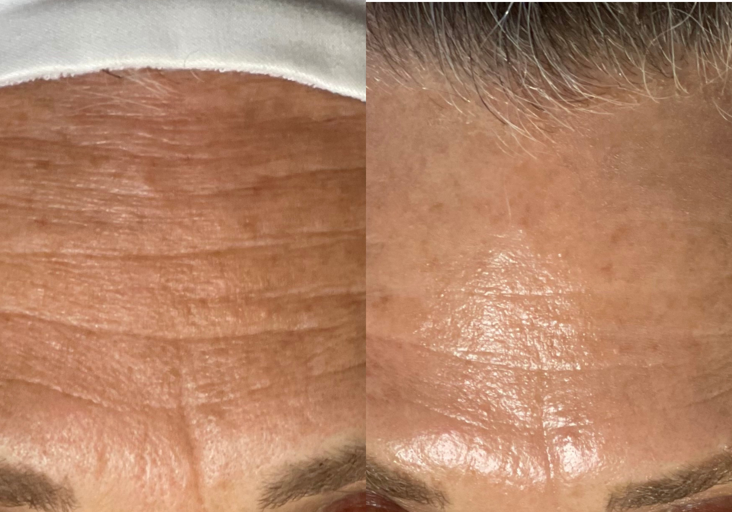 Before and After HydraFacial Treatment for Signs of Aging