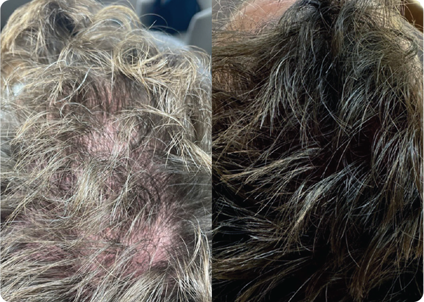 Before and After HydraFacial Keravive Treatment for Thinning Hair
