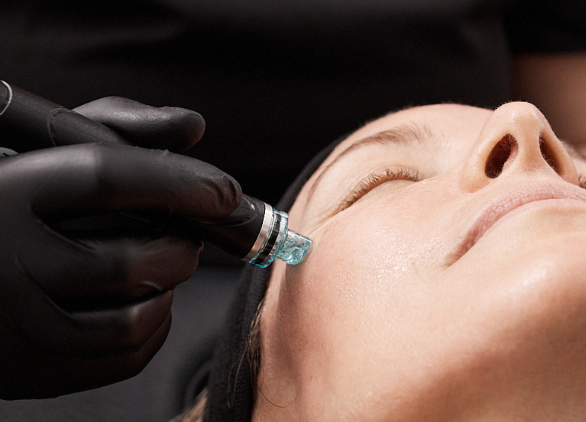 Step 3: Gentle Acid Peel with GlySal Solution
