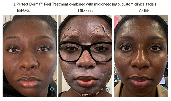 Before and After Chemical Peel for Active Breakouts