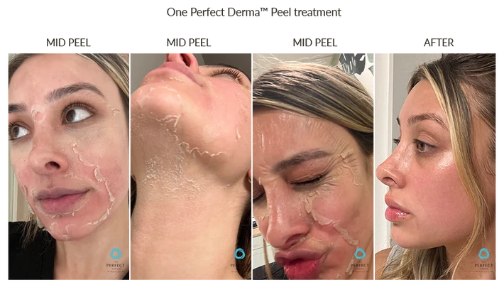 Before and After Back Chemical Peel