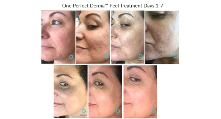 Before and After Chemical Peel for Cystic Acne