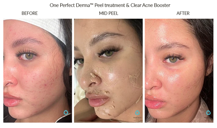 Before and After Neck and Chest Chemical Peel