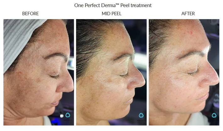 Before and After Chemical Peel for Anti-Aging