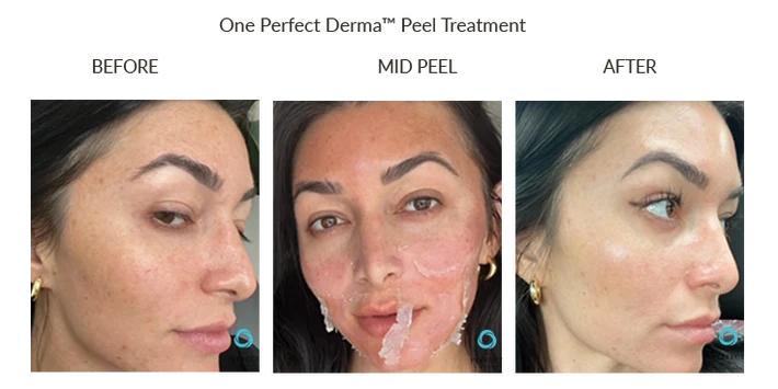 Before and After Hand Chemical Peel