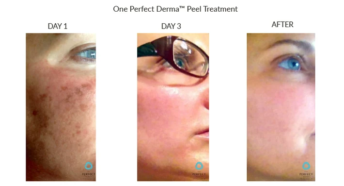 Before and After Chemical Peel for Melasma
