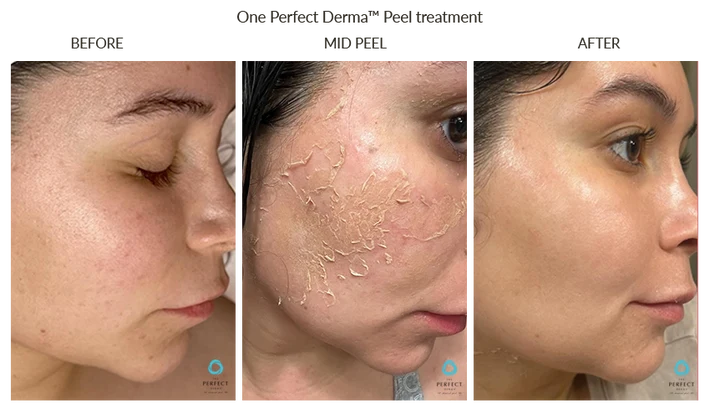 Before and After Chemical Peel for Deep Pigmentation