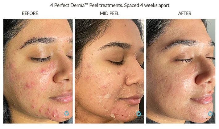 Before and After Chemical Peel for PIH