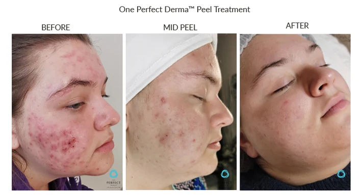 Before and After Chemical Peel for Sun Damage