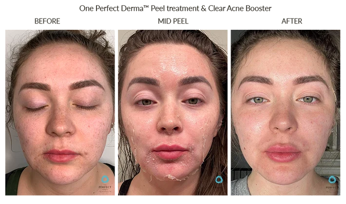 Before and After Chemical Peel for Skin Texture