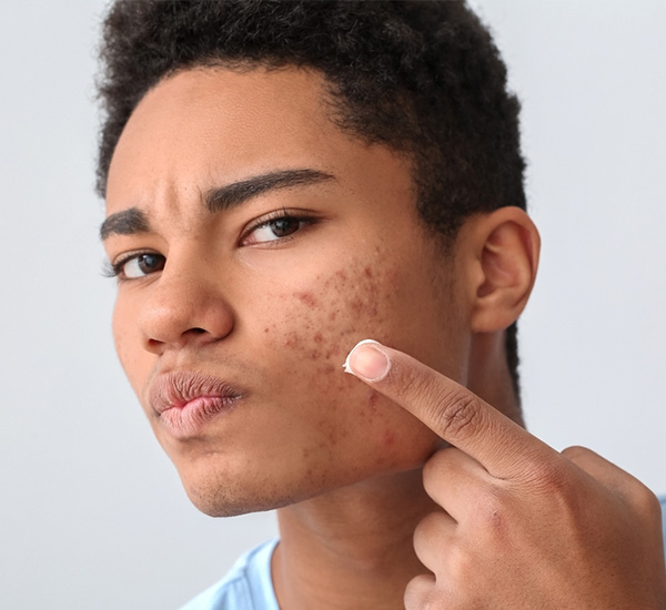 Clinical Acne Scar Remodeling