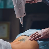Selective Photothermolysis Hair Removal