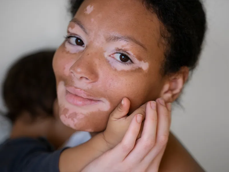 Close-up of vitiligo-affected person smiling