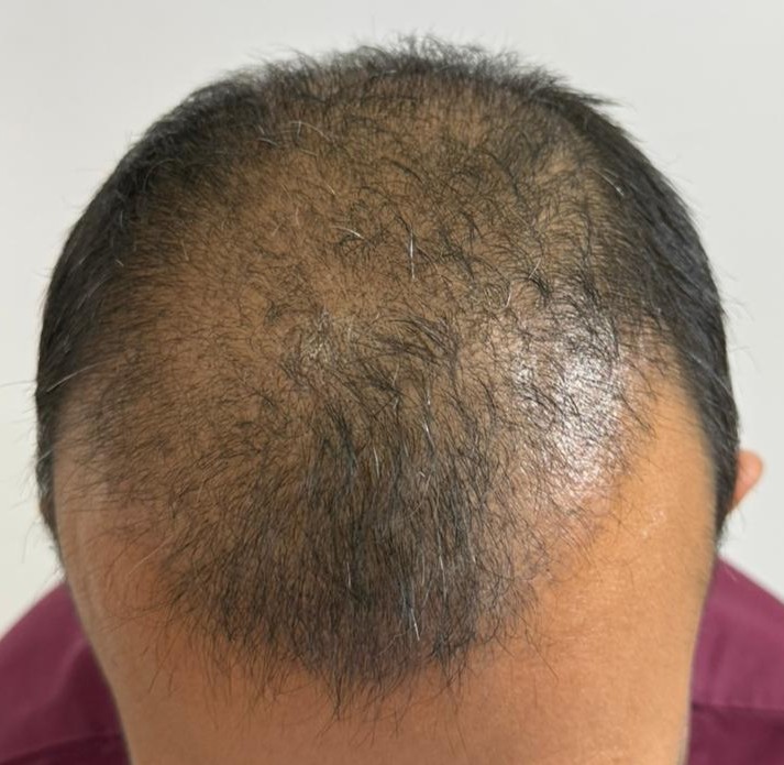 A person with short curly hair points to on their cheek needs acne treatment in Kampala at Refine Skin & Body clinic.
