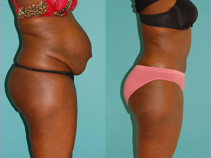 Before and after transformation of Abdominoplasty